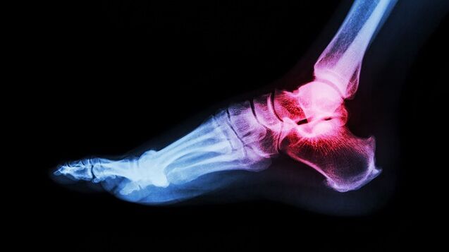 tretiranje artroza sklop bol u koljenu uzrok