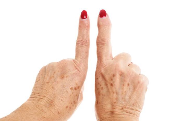 deformirajoča artroza na prstih