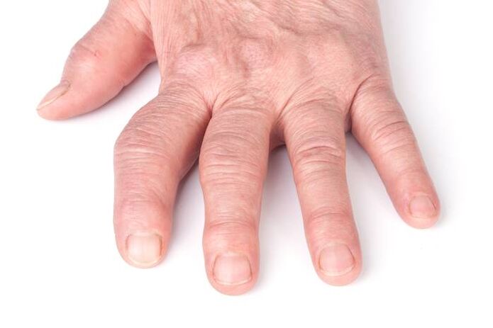 deformirajoča artroza na rokah