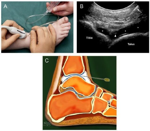 ultrazvok gleženjskega sklepa z artrozo