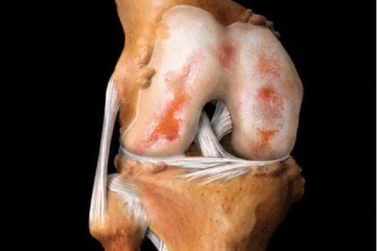 poškodba kolenskega sklepa z artrozo