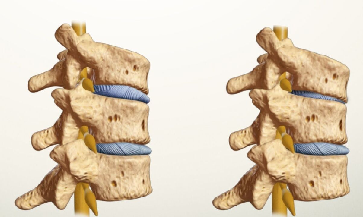 zdrava in bolna hrbtenica z ledveno osteohondrozo
