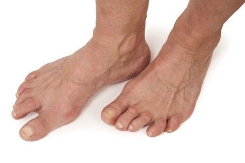 stopala, prizadeta zaradi artroze