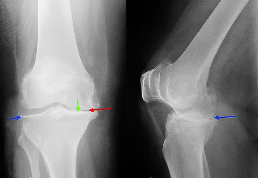 rentgenska slika artroze kolenskega sklepa