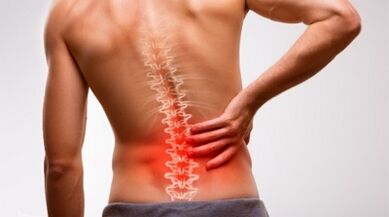 Znaki in simptomi osteohondroze ledvene hrbtenice