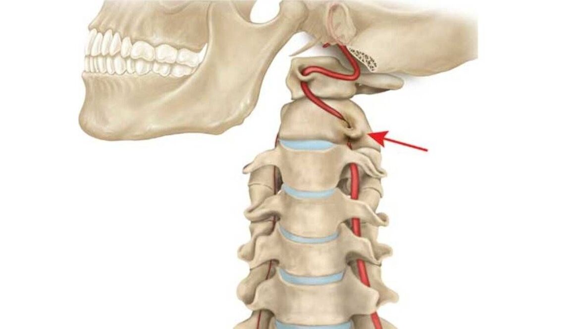 osteohondroza vratne hrbtenice