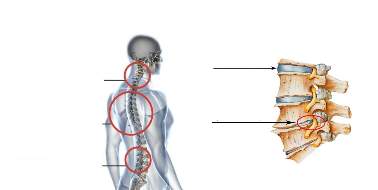 ostehondroza hrbtenice
