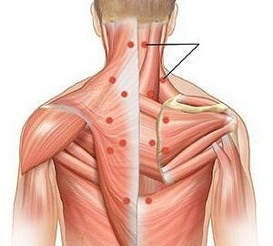 miozitis kot vzrok za bolečine v hrbtu