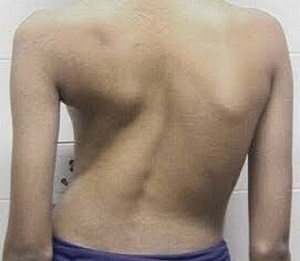 skolioza kot vzrok za bolečine v hrbtu