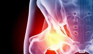 razlogi za razvoj artroze kolka