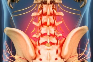 vzroki in simptomi osteohondroze