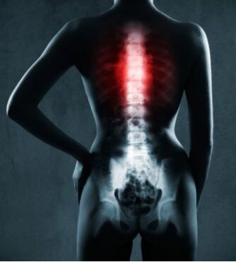 Prizadeto območje hrbtenice s torakalno osteohondrozo