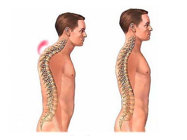 Kifoza hrbtenice