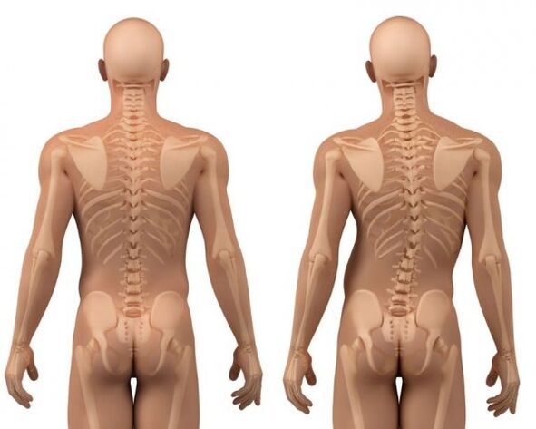 Skolioza hrbtenice