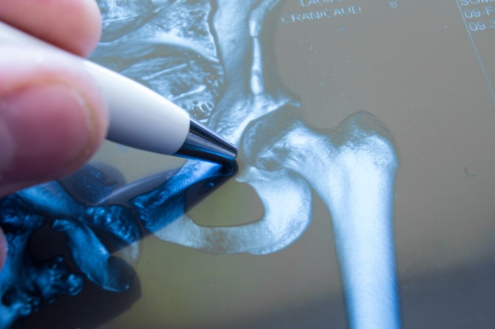 Artroza kolčnega sklepa na radiogramu