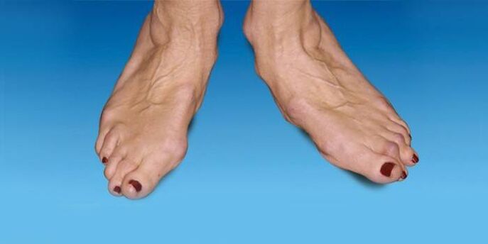 deformacija stopala z artrozo gležnja