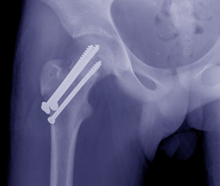 Rentgen kolčnega sklepa, osteosinteza zloma z napravami za notranjo fiksacijo