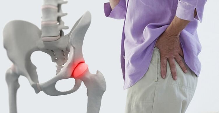 bolečina v predelu kolka - simptom artroze kolčnega sklepa
